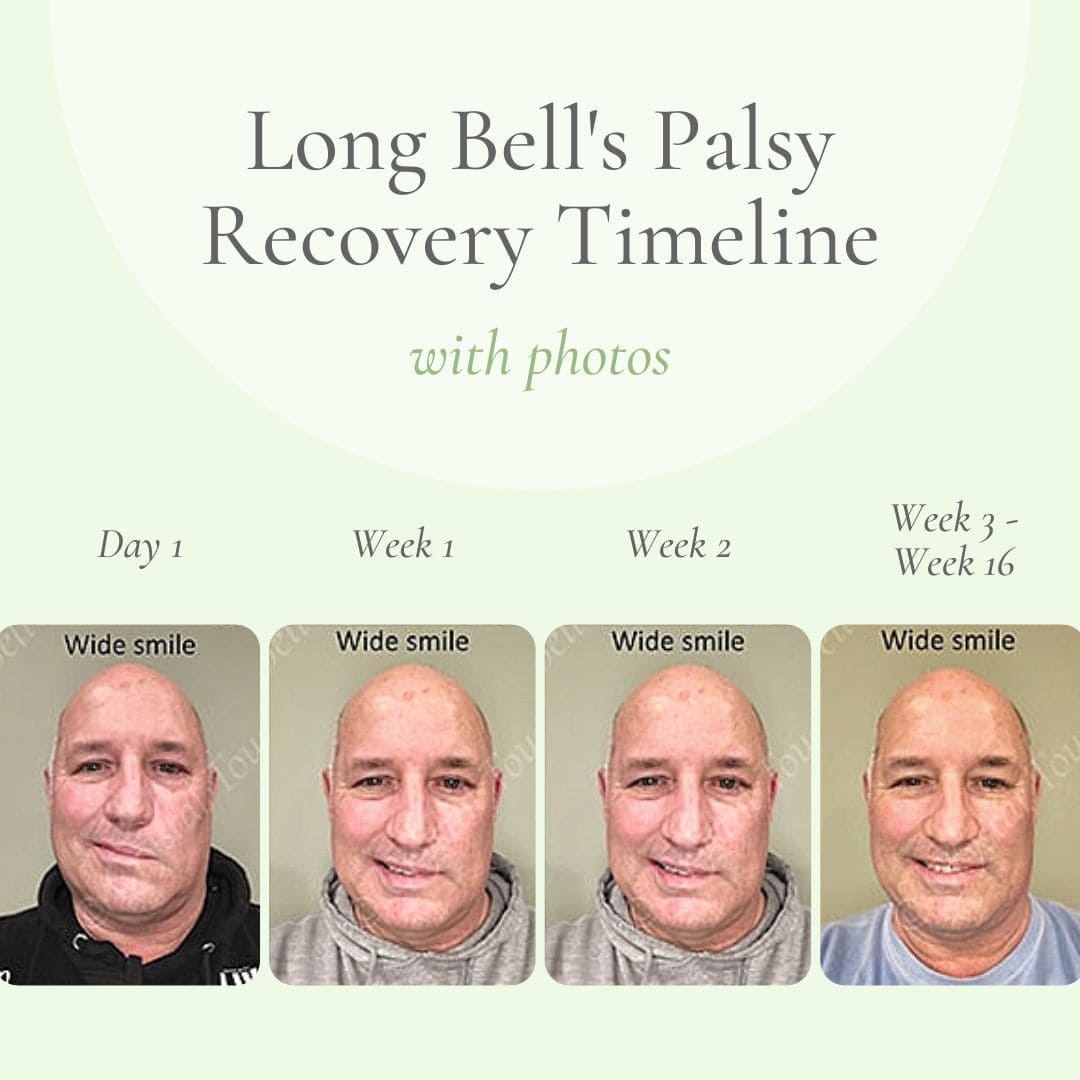 Bell’s Palsy Recovery: Fastest Ways, Stages & Timeline