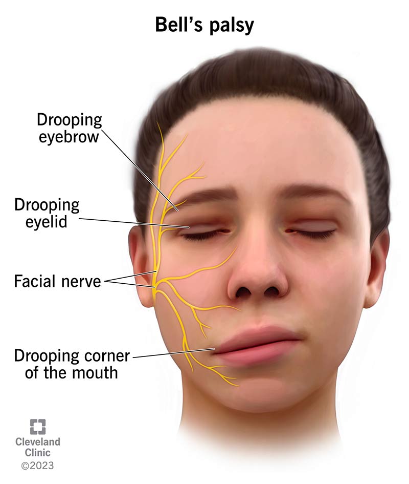 Bell’s Palsy Treatment: Fast, Safe & Effective Options