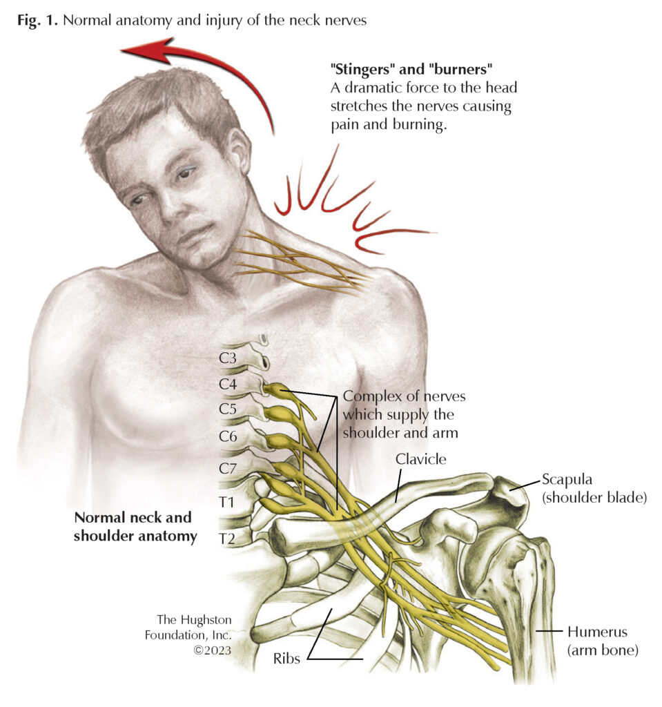 Brachial Neuritis Causes: What Triggers This Pain