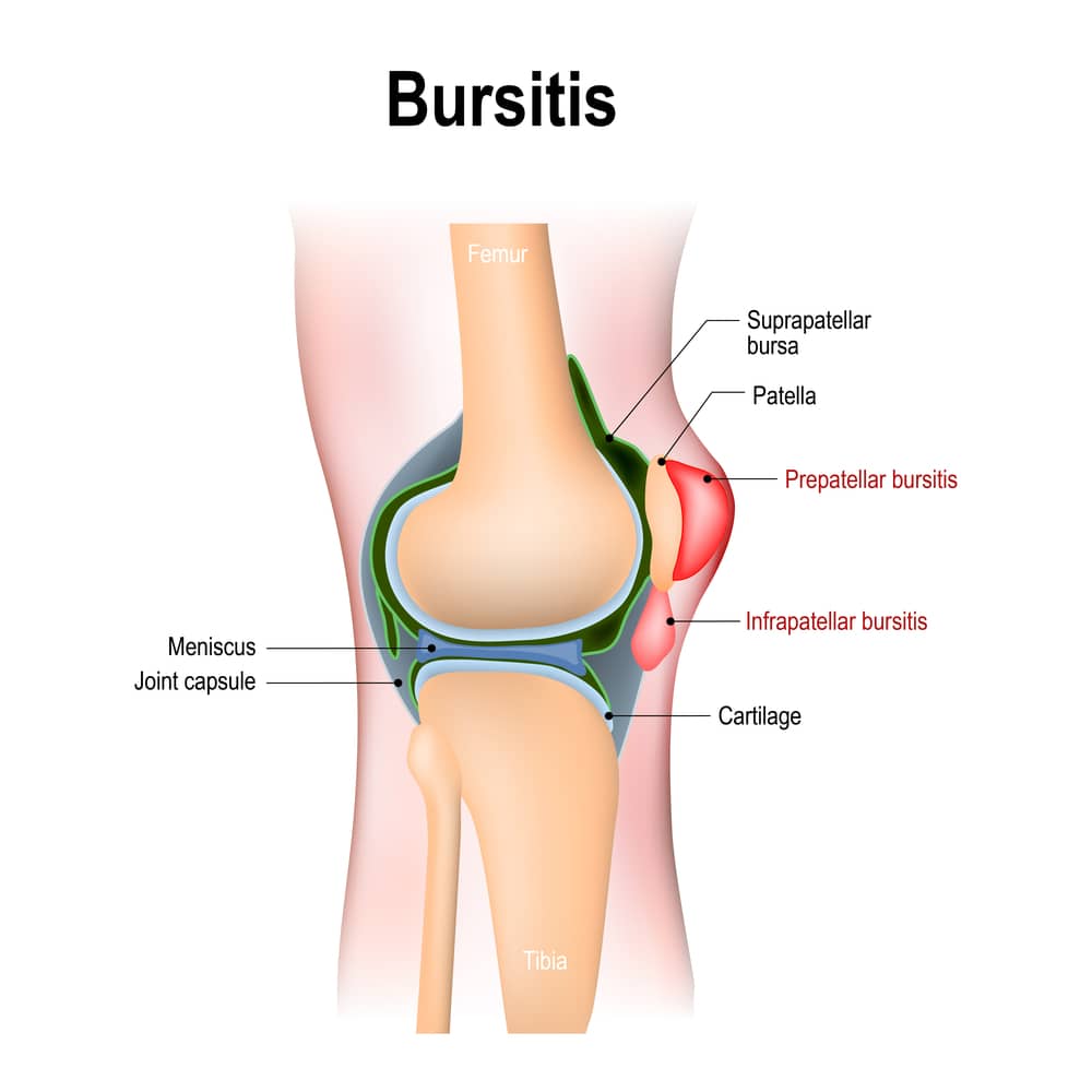 Bursitis Treatment Options: What Really Works for Relief