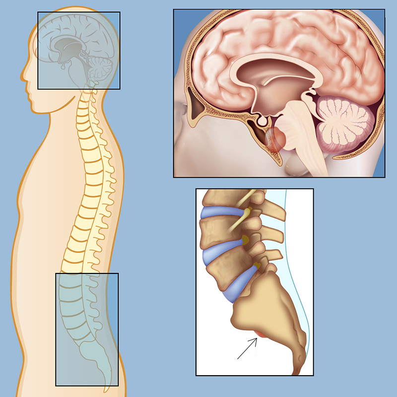 Chordoma Symptoms: What You Need to Know Today