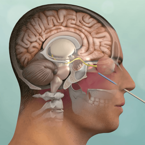 Chordoma Treatment: Options, Risks, and What to Expect