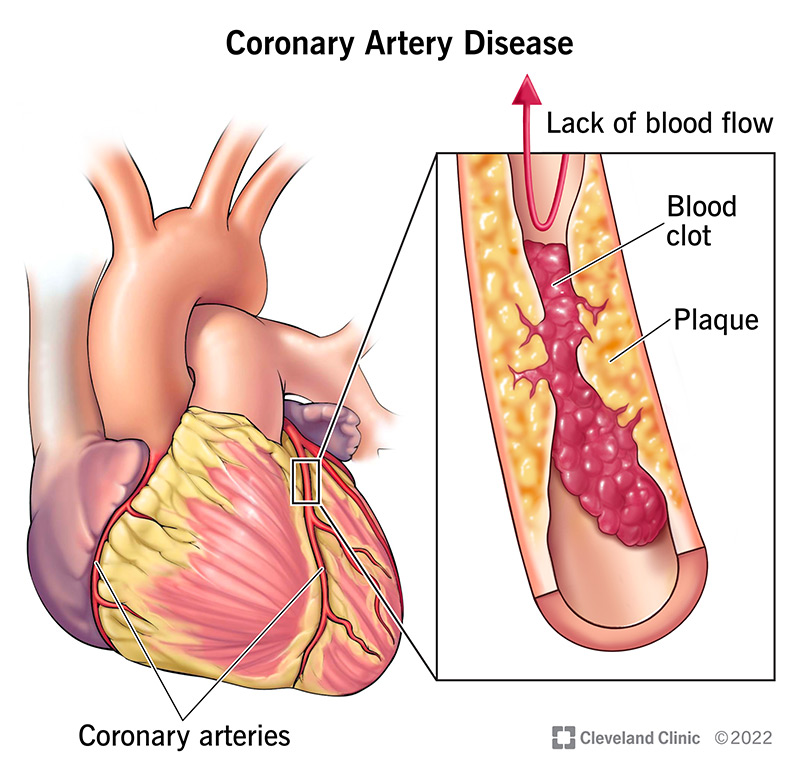 Coronary Artery Clot: What It Means, Risks & Treatment