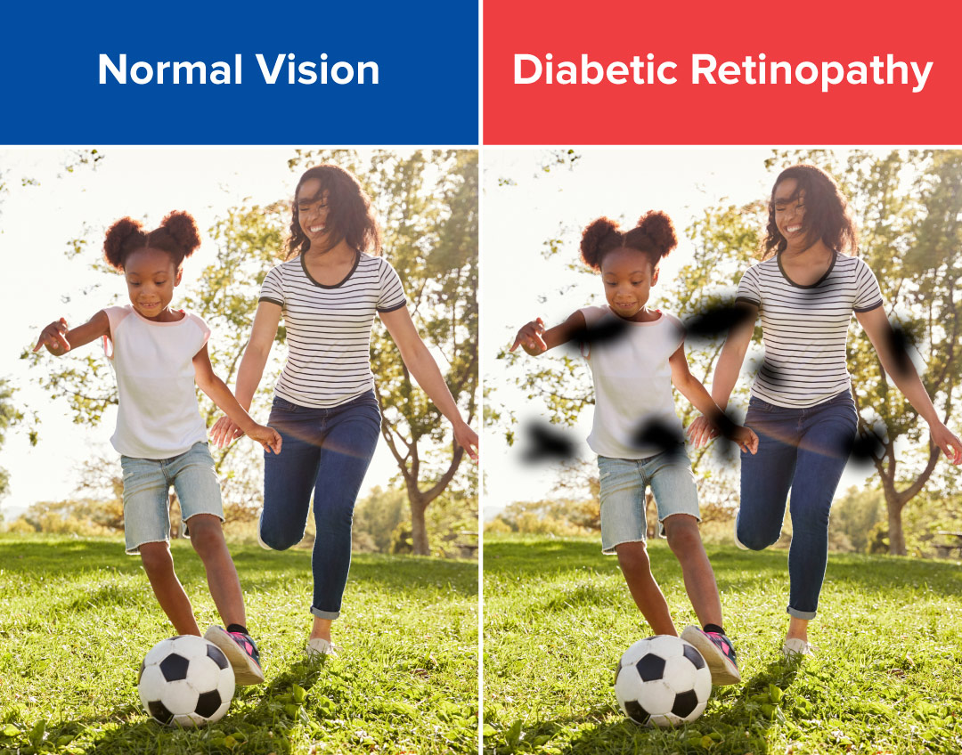Diabetes Vision Loss: Risks, Signs & Simple Protection