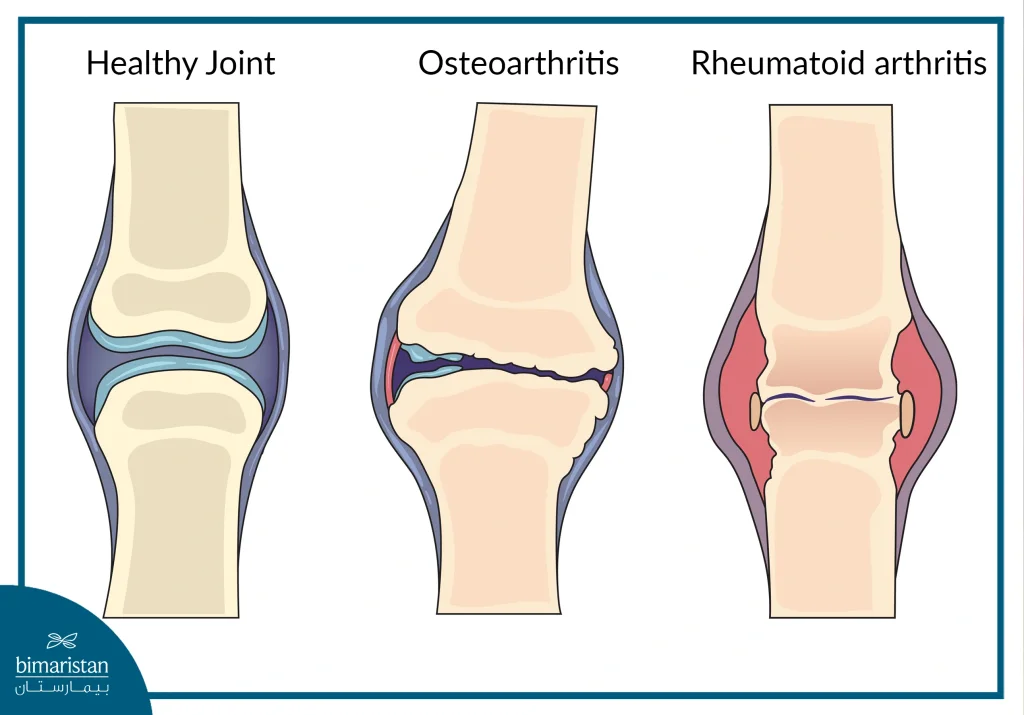 Diagnosing Arthritis: Quick Answers and What Comes Next