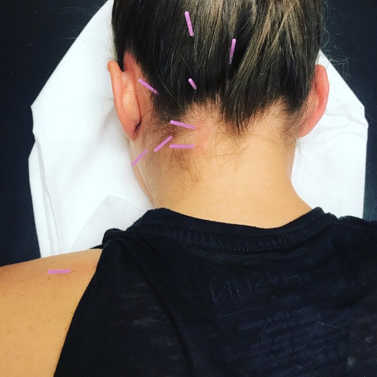 Dry Needling Migraine: Fast Relief & What to Expect