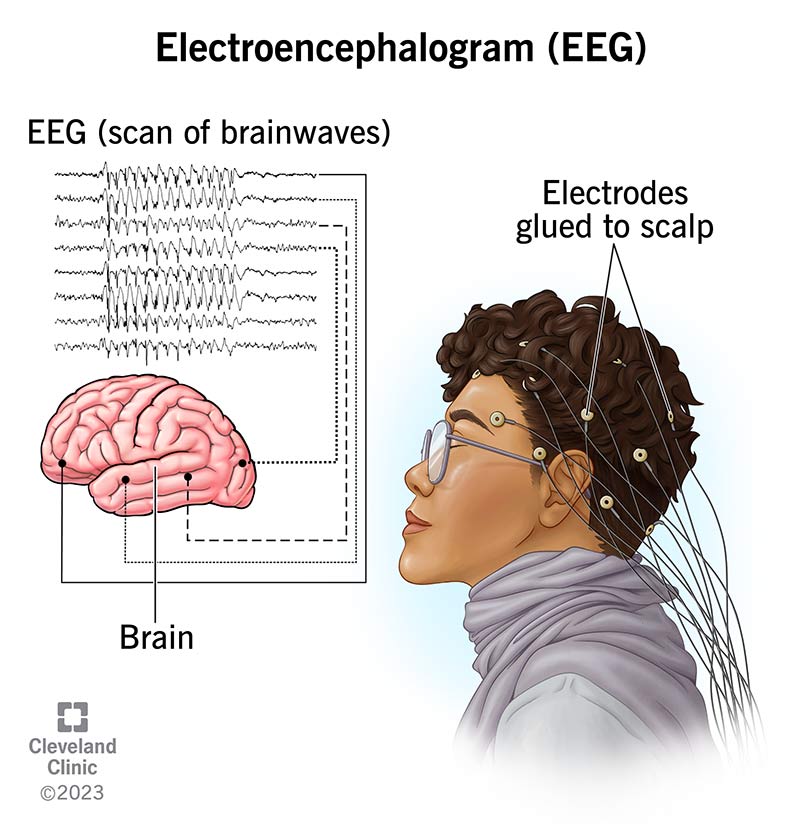 EEG for Seizures: Quick Answers & What to Expect