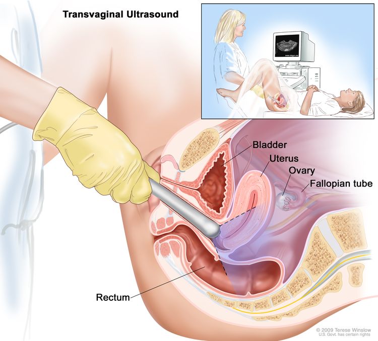 Endometrial Cancer Surgery: What You Need to Know