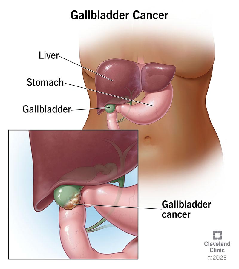 Gallbladder Cancer – Symptoms, Causes & Treatment