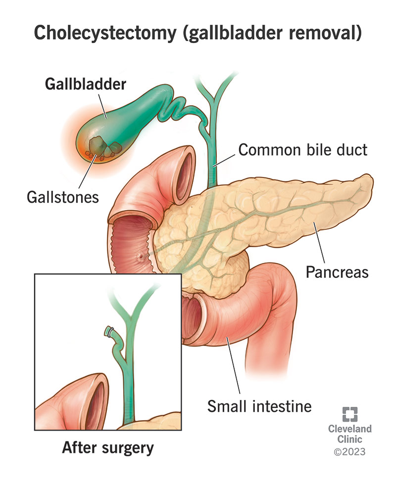 Gallbladder Removal Reasons: What You Need to Know
