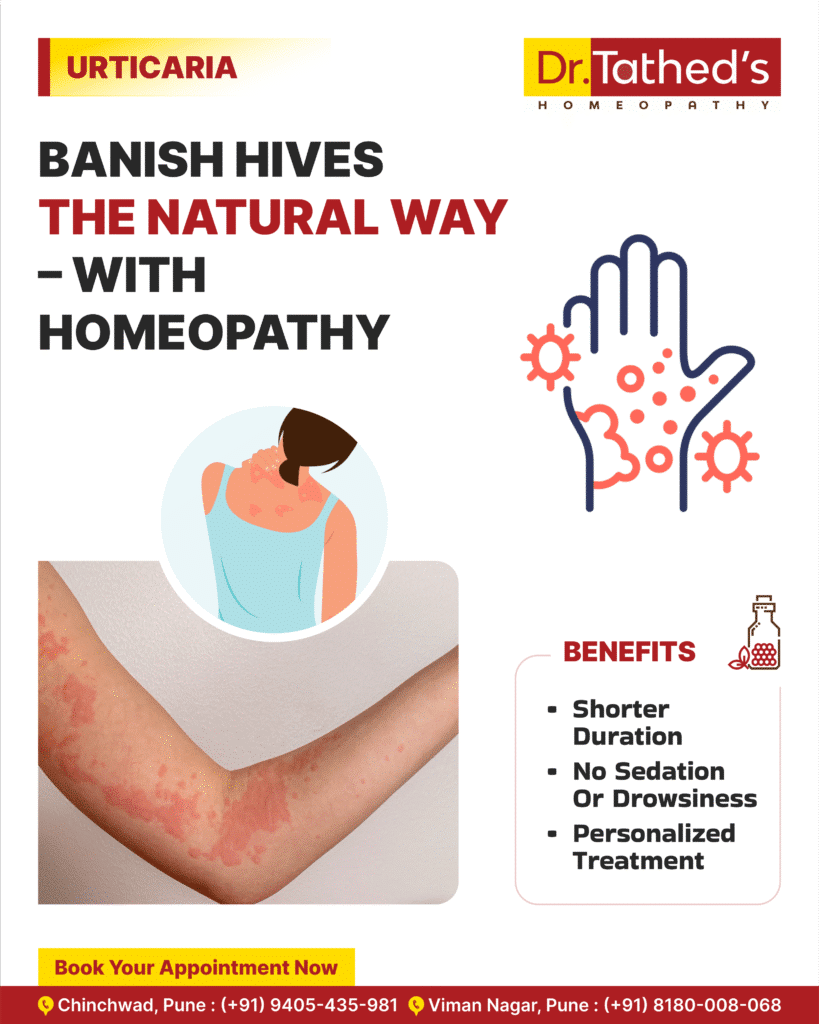 Homeopathic Hives Treatment: Safe, Proven Remedies & What to Expect