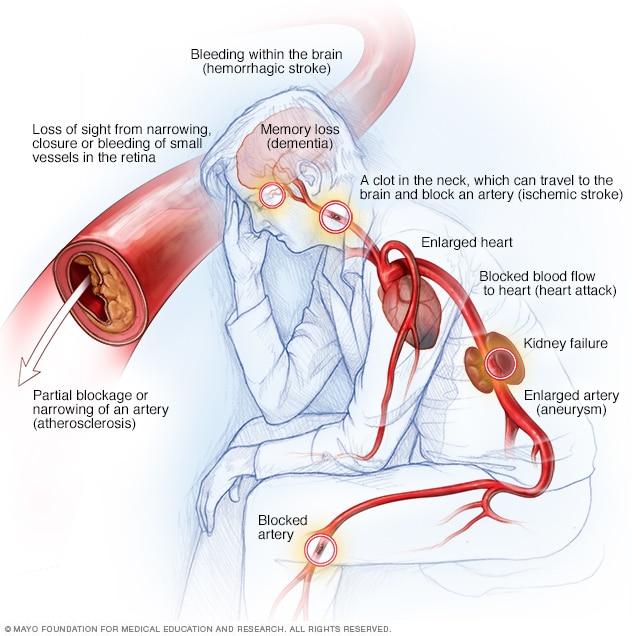 Hypertension and Stroke: Why Blood Pressure Matters