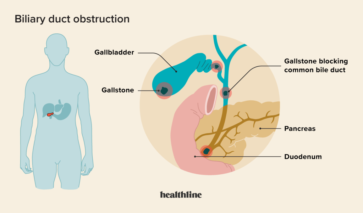 Jaundice Gallbladder Disease: Causes, Signs & Treatment
