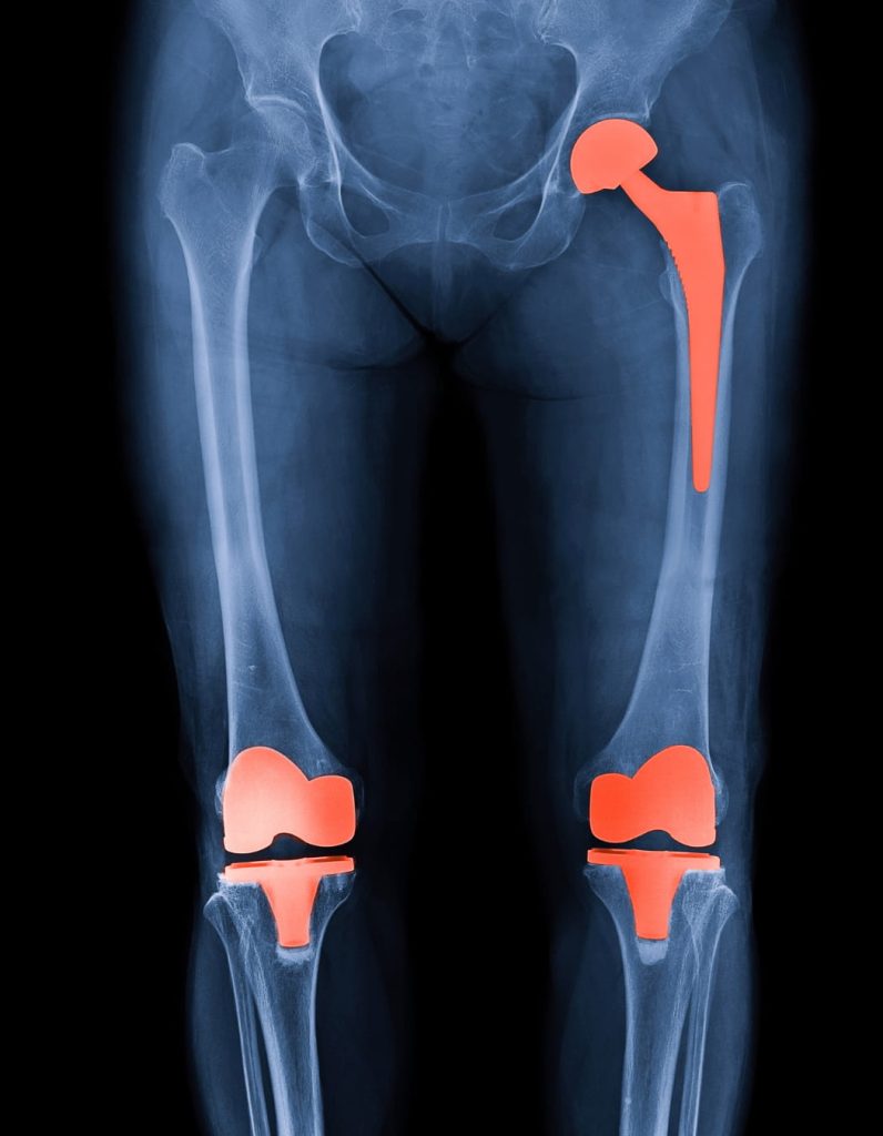 Knee Pain After Hip Replacement: Causes & Relief