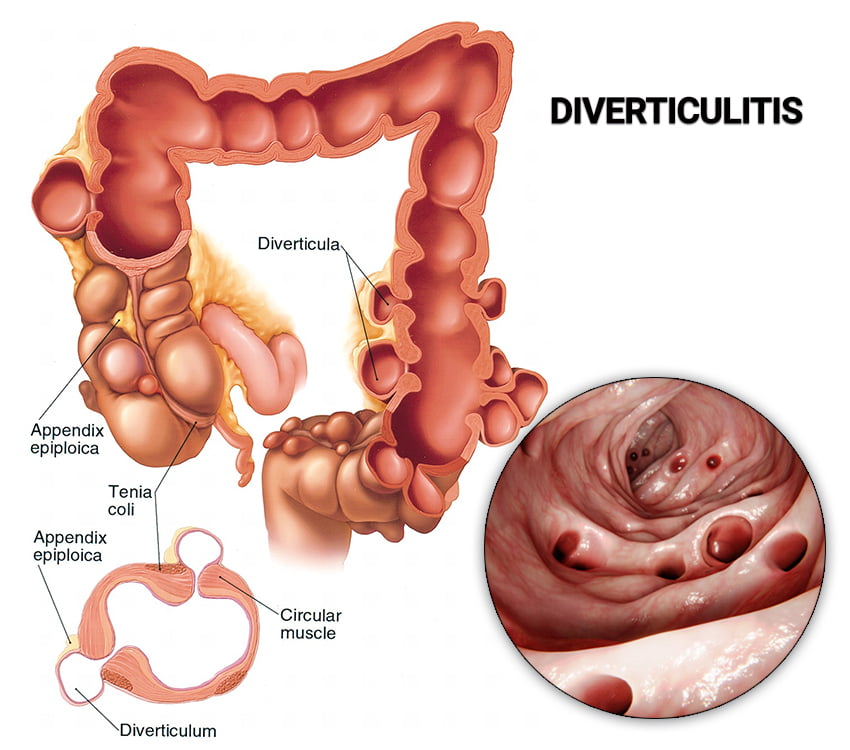Left Colon Gas: Causes, Relief & When to Worry