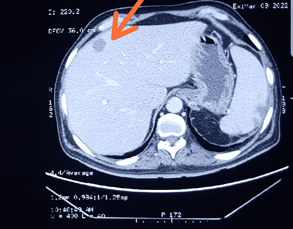 Liver Lymphoma: Essential Facts You Need to Know