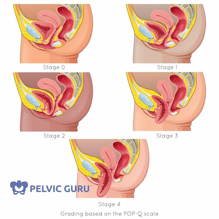 Menopause Pelvic Pain: Find Real Relief & Understanding