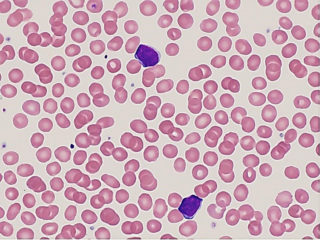 Monoclonal B‑Cell Lymphocytosis: Key Facts & Outlook