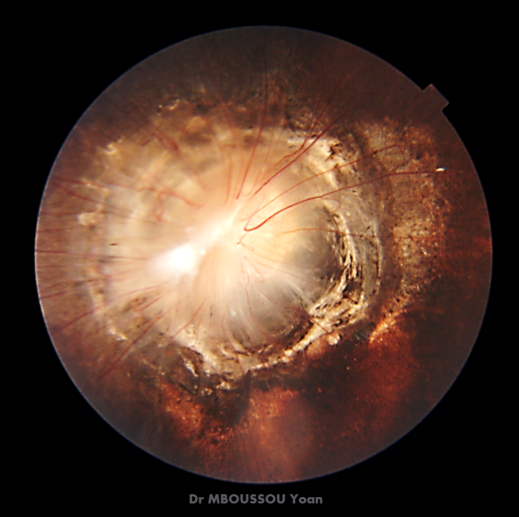 Morning Glory Retina: Causes, Symptoms & Treatment