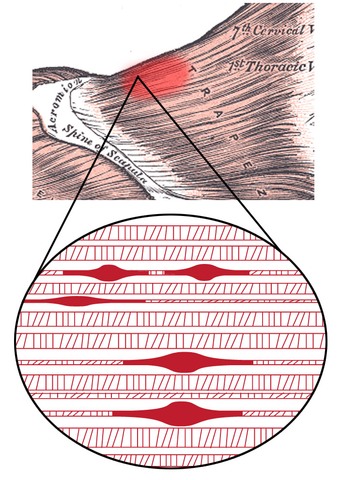Muscle Trigger Points: Unlock Relief & Faster Healing