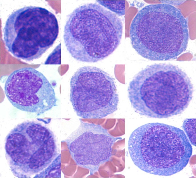 Myelomonocytic Leukemia – What You Need to Know Now