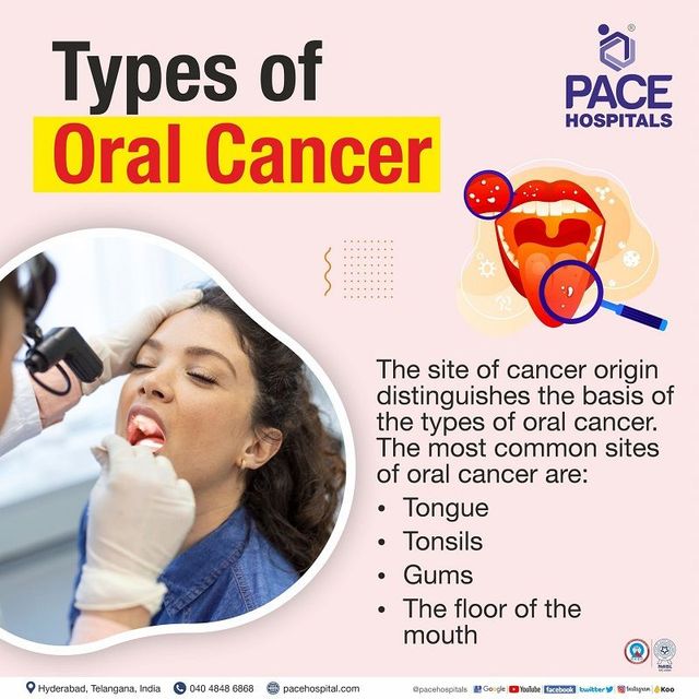 Oral Cancer Types: What They Are and How to Spot Them