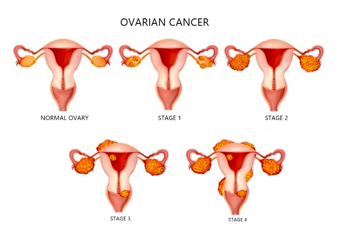 Ovarian Cancer Staging: What You Need to Know Today
