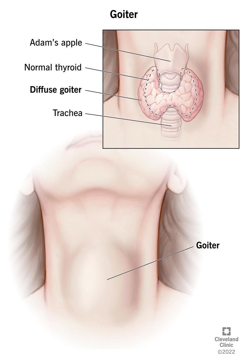 Painless Thyroid Lump – What It Is, When to Worry & How to Manage