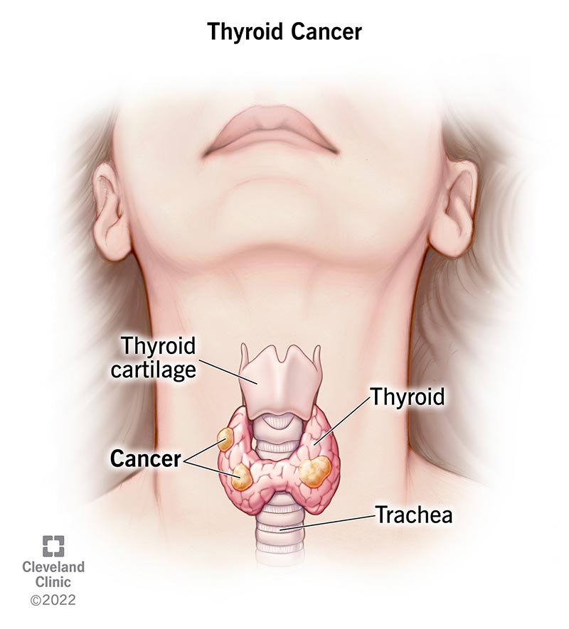 Papillary Thyroid Cancer: Symptoms, Treatment & Survival