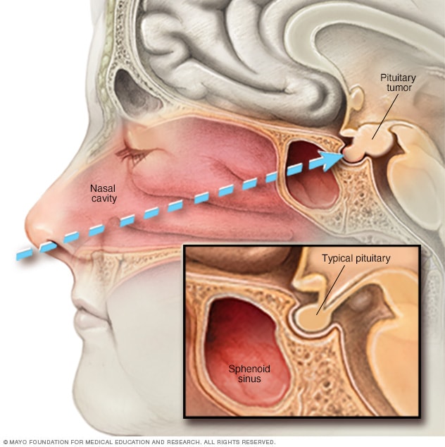 Pituitary Tumor Medication: Options, Benefits & Risks