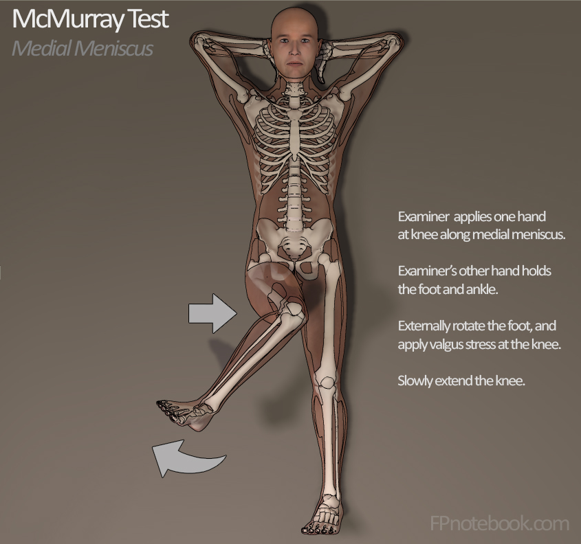 Your Complete Guide to a Positive McMurray Test