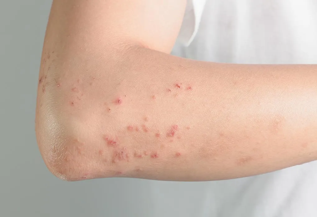 Postpartum Urticaria: Quick Relief & Safe Treatment