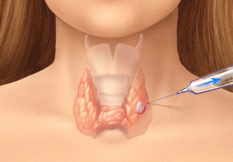 PTC Treatment: Options, Risks, and What to Expect