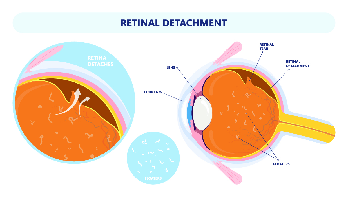 Understanding Retinal Detachment Risk: What You Must Know
