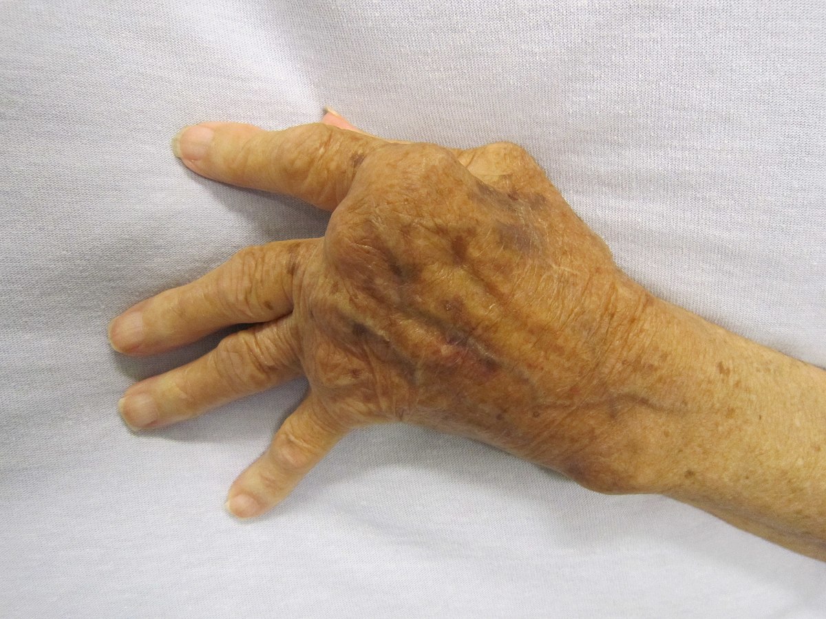 Rheumatoid Arthritis – Symptoms, Causes & Treatment Explained