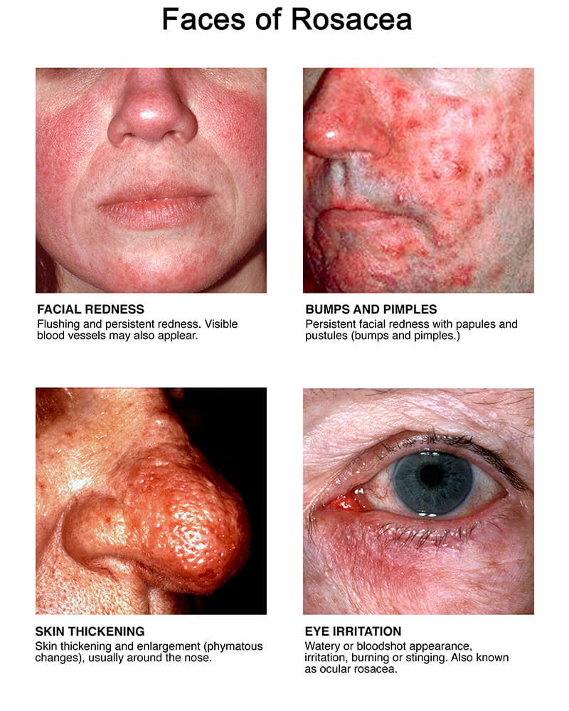 Rosacea Pictures – A Visual Guide to Every Stage