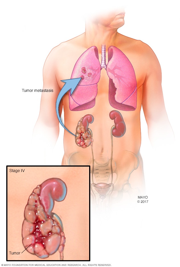 Stage 4 Kidney Cancer: What You Need to Know