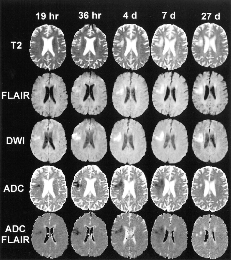 Stroke MRI Duration: How Long Does the Scan Take?