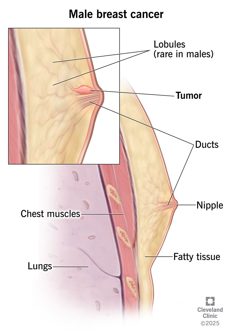Testicular Cancer Breast Growth: Signs & What to Do