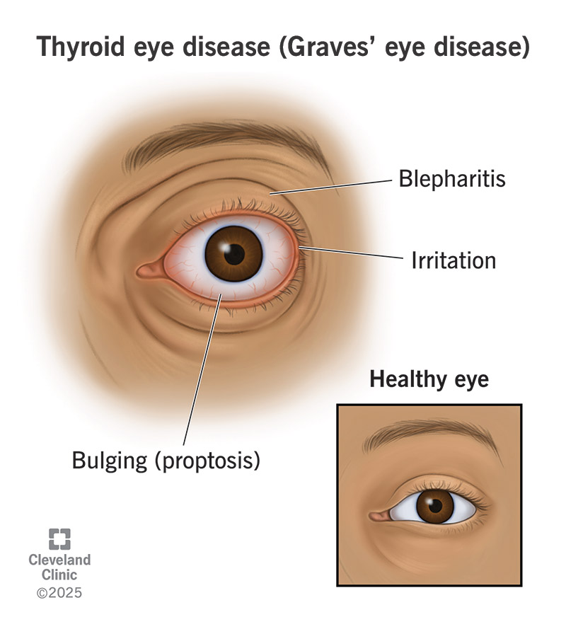 Thyroid Eye Disease Causes: What You Need to Know
