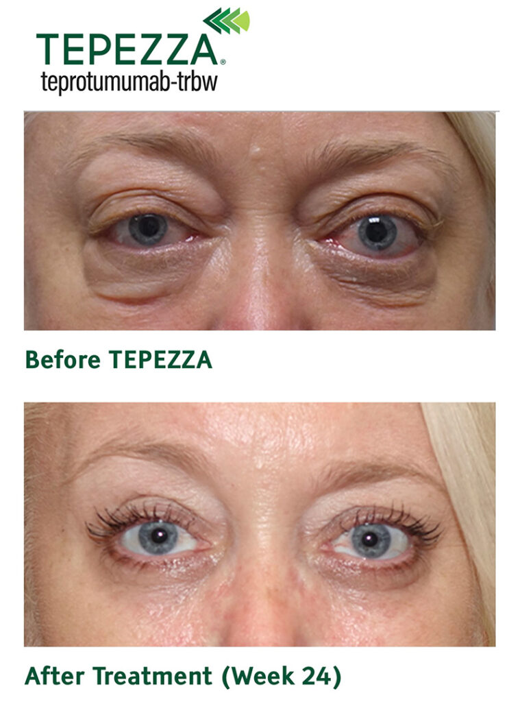 Thyroid Eye Disease Medication: Hope, Risks & Real Answers