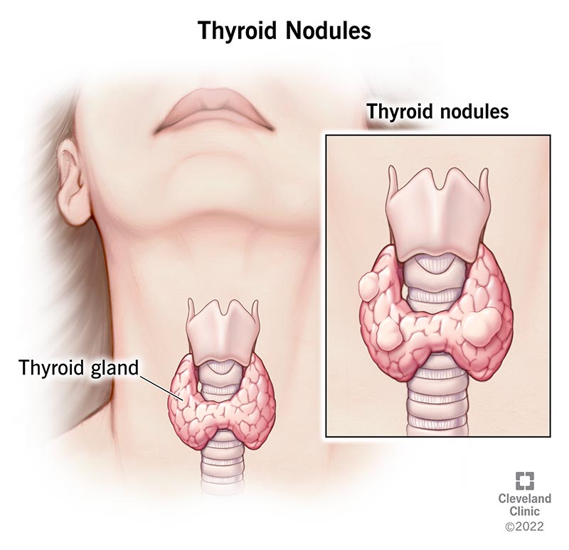 Thyroid Nodule – Causes, Symptoms, Risks & Treatment