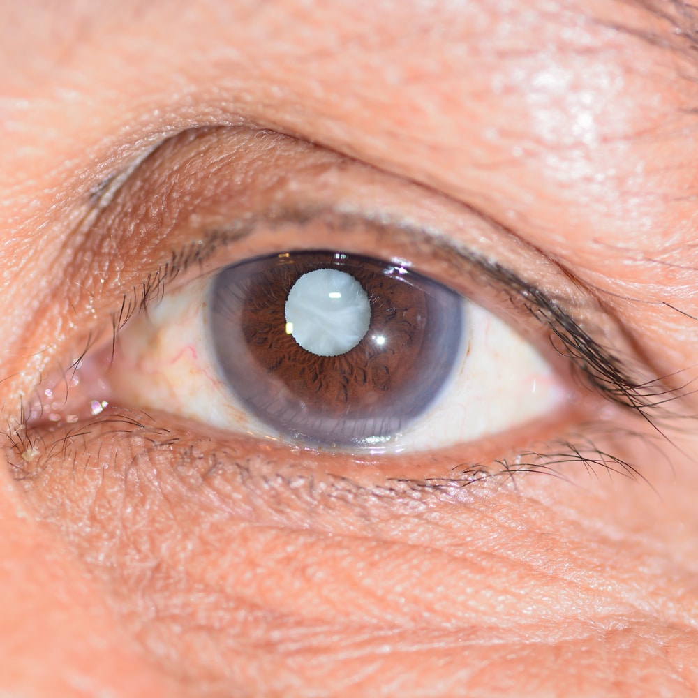 Traumatic Cataract: Causes, Types & Treatment