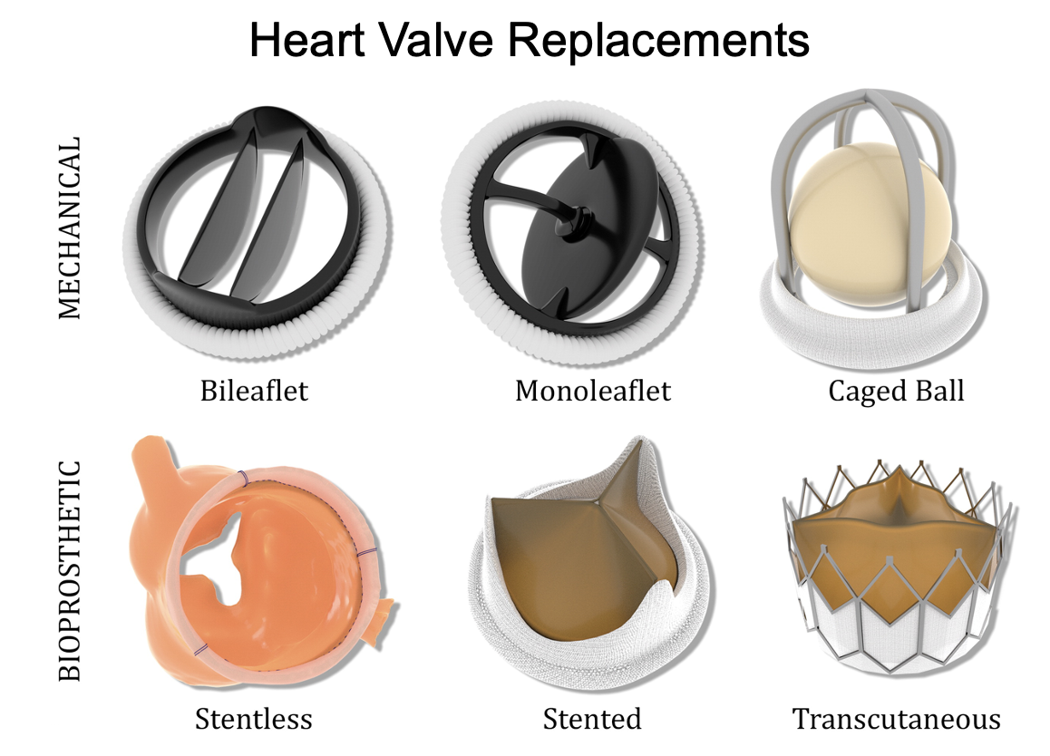 Valve Replacement Options: What You Need to Know