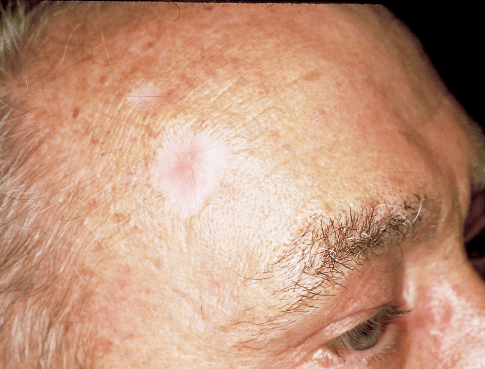 White Spot Skin Cancer: Signs, Risks & What to Do
