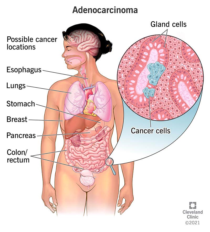 Abdominal Cancer: Key Symptoms, Types & What to Do