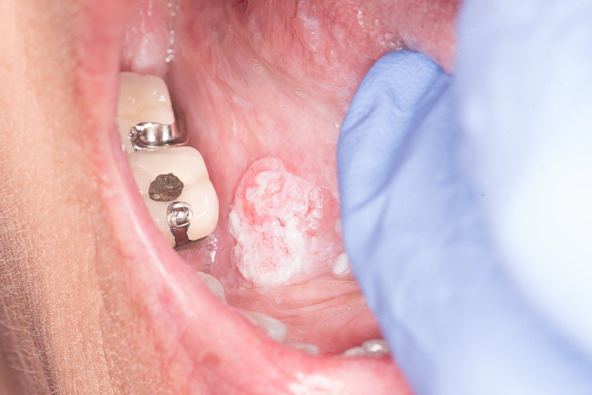 Advanced Oral Cancer Treatment: What You Need to Know