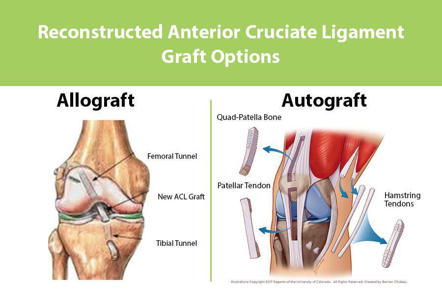 Allograft vs Autograft: What’s Best for Your Recovery?