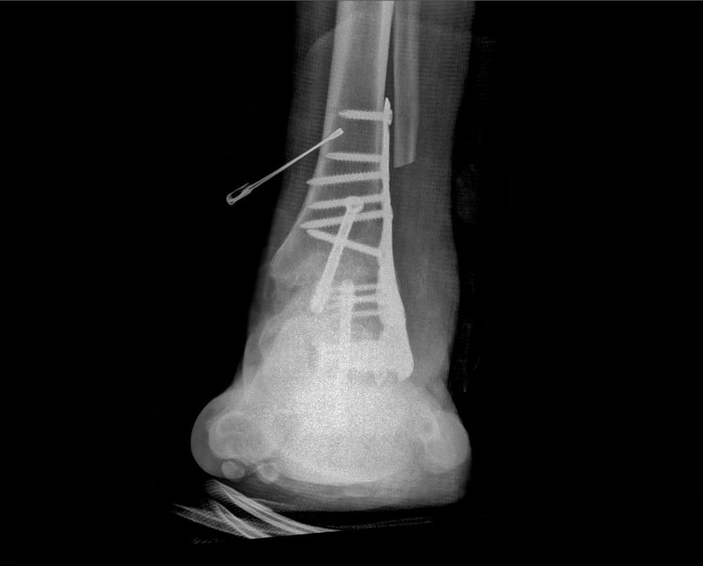 Ankle Fusion Complications: What to Expect and Manage