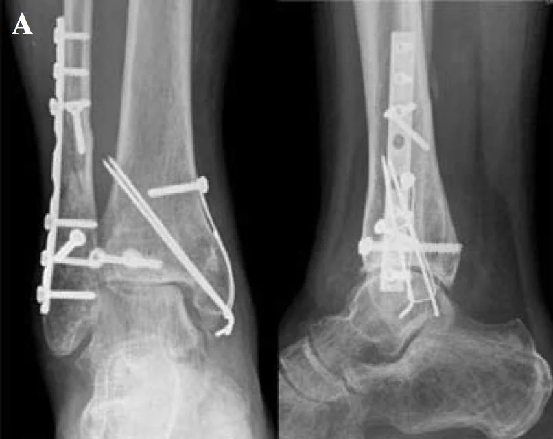 Ankle Fusion Therapy: What It Is, Recovery & Life After